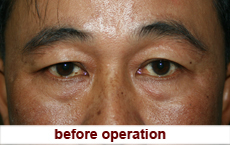 plastic-surgery-blepharoplasty